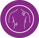 Melanoma